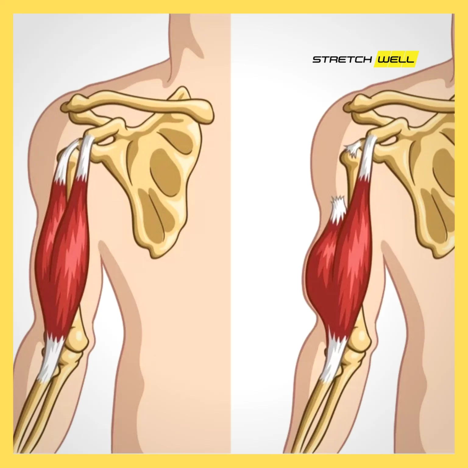 Ruptura bicepsa
