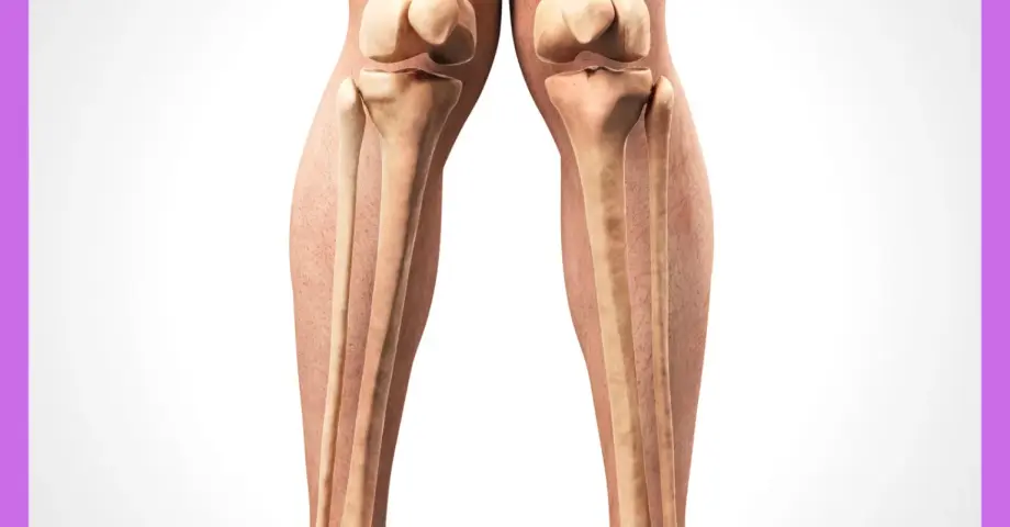 Genu Valgum – «X legs»